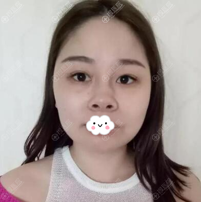 选择找杭州美联致美整形医院吴明龙做隆鼻只因不想被人叫猪鼻子