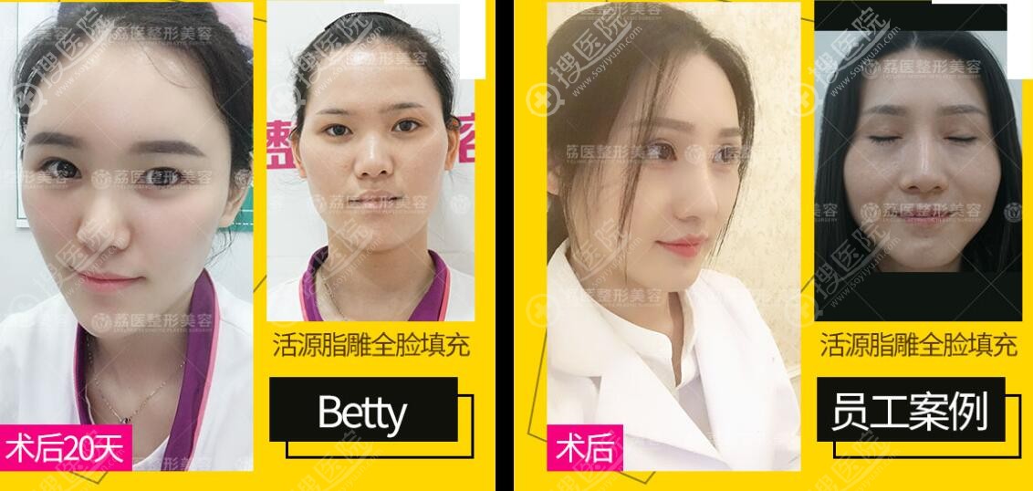 广州荔医活源脂雕面部填充效果 广州荔医活源脂雕面部填充效果