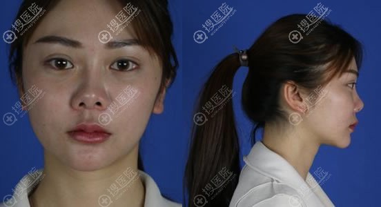 都说鼻修复手术伤害大别做,可我找昆明艺星晋超做鼻修复成功啦