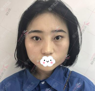 花近一万元在重庆铂生做了光纤溶脂瘦脸,术后3个月恢复图分享
