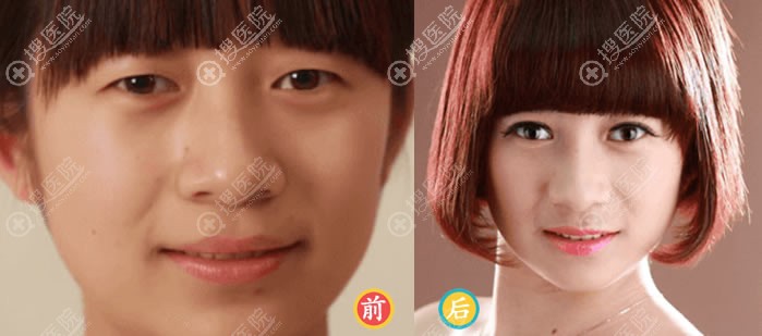 <!--<i data=20240710 data-id=11916></i>-->徐杰做双眼皮案例 <!--<i data=20240710 data-id=11916></i>-->徐杰做双眼皮案例