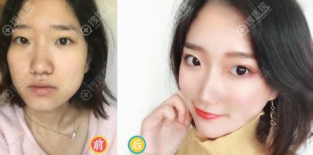 兰州时光逯岩自体脂肪填充全脸案例 兰州时光逯岩自体脂肪填充全脸案例