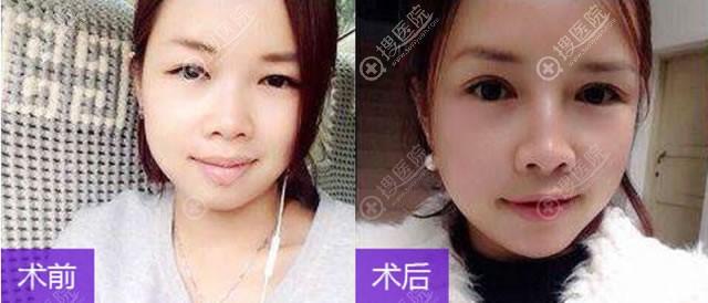 兰州时光整形罗梅做双眼皮案例 兰州时光整形罗梅做双眼皮案例