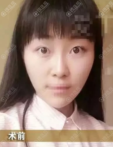 <!--<i data=20240710 data-id=11916></i>-->整形做双眼皮手术前 <!--<i data=20240710 data-id=11916></i>-->整形做双眼皮手术前