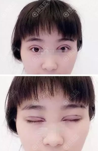 <!--<i data=20240710 data-id=11916></i>-->整形刚做完双眼皮照片 <!--<i data=20240710 data-id=11916></i>-->整形刚做完双眼皮照片