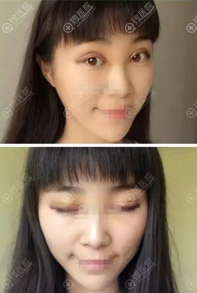 <!--<i data=20240710 data-id=11916></i>-->徐杰割双眼皮案例5天效果 <!--<i data=20240710 data-id=11916></i>-->徐杰割双眼皮案例5天效果