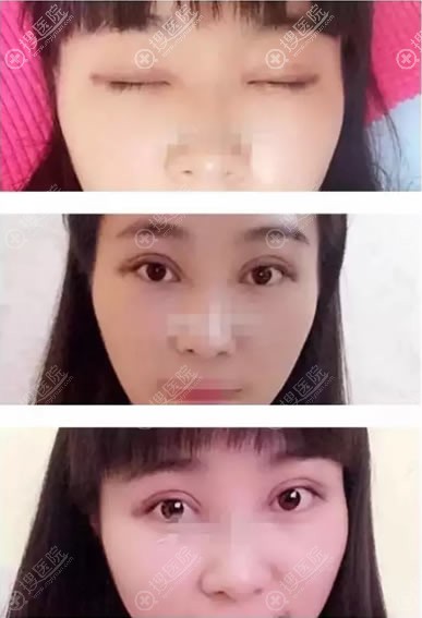 <!--<i data=20240710 data-id=11916></i>-->割双眼皮案例10天效果 <!--<i data=20240710 data-id=11916></i>-->割双眼皮案例10天效果
