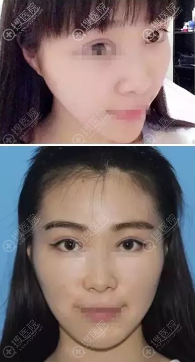 <!--<i data=20240710 data-id=11916></i>-->徐杰割双眼皮恢复过程 <!--<i data=20240710 data-id=11916></i>-->徐杰割双眼皮恢复过程