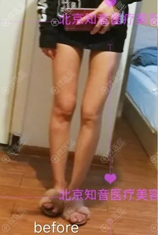 我与O型腿抗争了十年,终于在北京知音蕊丽找到方法并成功矫正