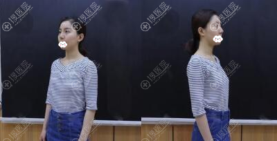 说说在重庆军美整形医院找胡金香自体脂肪丰胸2填一年后的感受