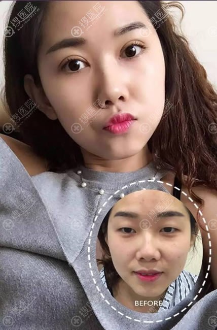 兰州韩美整形双眼皮案例 兰州韩美整形双眼皮案例