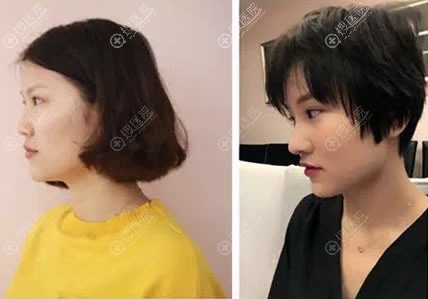 兰州韩美整形鼻综合隆鼻案例 兰州韩美整形鼻综合隆鼻案例
