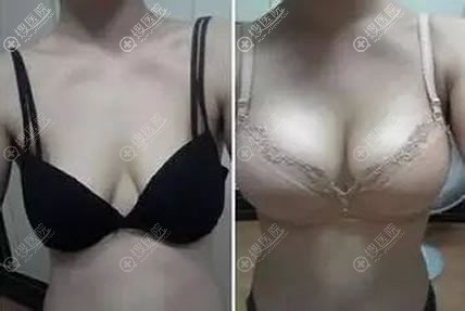 兰州韩美整形假体隆胸案例 兰州韩美整形假体隆胸案例