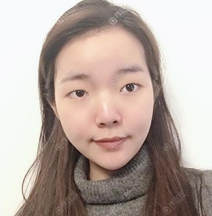 兰州整形医院推荐:在韩美做完双眼皮和隆鼻后觉得韩美就挺不错