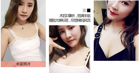 太原华美罗盛康假体隆胸案例 太原华美罗盛康假体隆胸案例