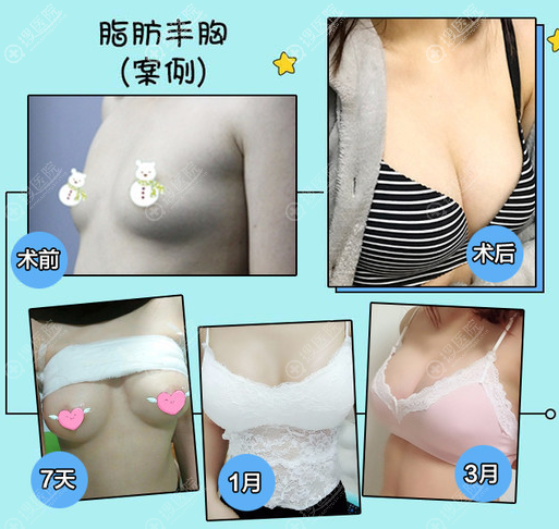 太原欧美莲姚冰主任做的隆胸案例 太原欧美莲姚冰主任做的隆胸案例