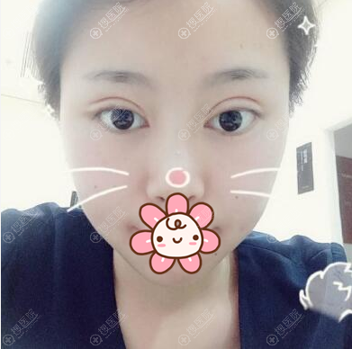 �п�˫��Ƥ�������»ָ�Ч��
