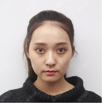 喜欢小v脸的我花8万元找重庆华美潘宝华做了颧骨颧弓下颌角整形