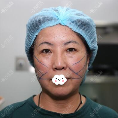 <!--<i data=20240710 data-id=12045></i>-->陈瑞红线雕术前设计 <!--<i data=20240710 data-id=12045></i>-->陈瑞红线雕术前设计