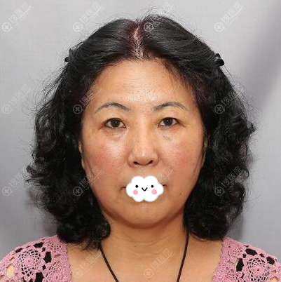 面部埋线提升术前照片 面部埋线提升术前照片