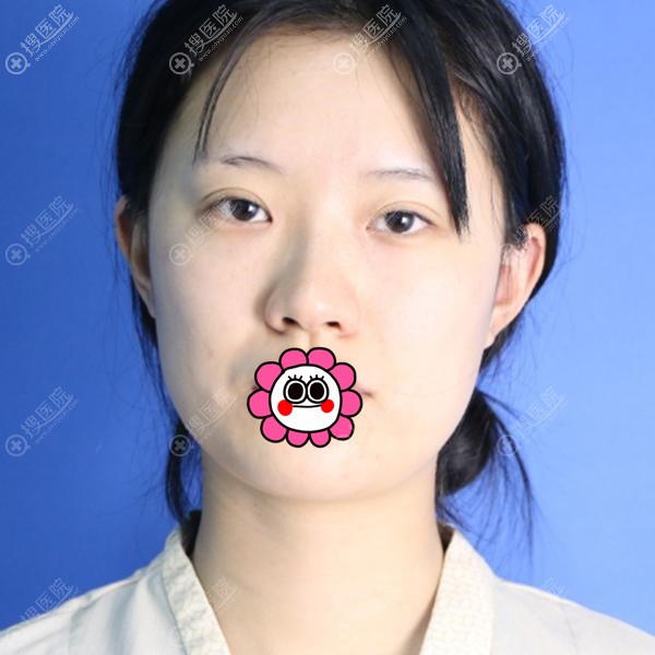 初次整形到昆明艺星找晋超做自体脂肪填充面部后有了少女即视感