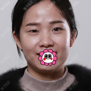 大小眼的我找王英明做双眼皮后就知道南宁广丽医疗美容好吗