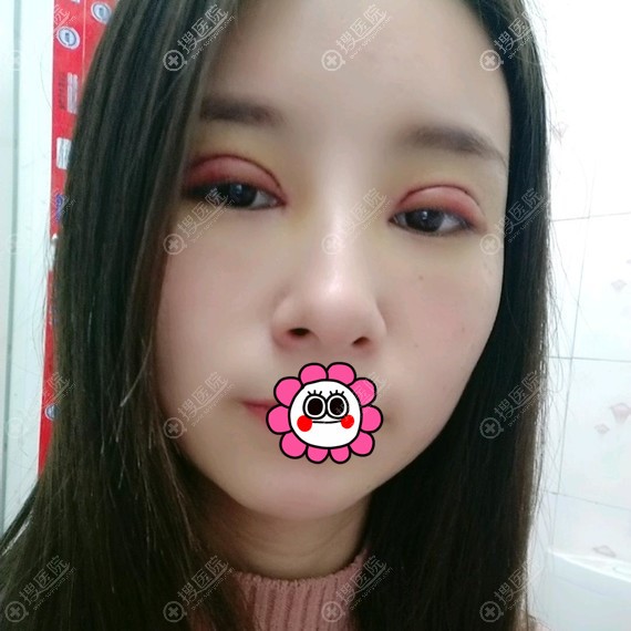 郑州菲林双眼皮恢复5天 郑州菲林双眼皮恢复5天