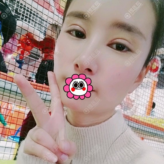 郑州菲林双眼皮术后10天效果 郑州菲林双眼皮术后10天效果