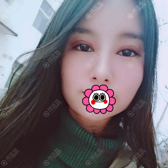 郑州菲林双眼皮一个月效果很自然 郑州菲林双眼皮一个月效果很自然