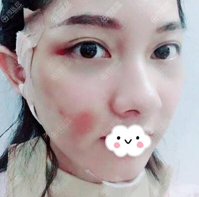 王权面部吸脂埋线提升术后即刻 王权面部吸脂埋线提升术后即刻