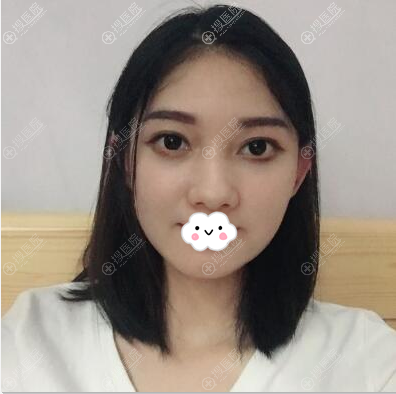 <!--<i data=20240710 data-id=13072></i>-->(原雅唯)王权面部线雕吸脂术后7天效果 <!--<i data=20240710 data-id=13072></i>-->(原雅唯)王权面部线雕吸脂术后7天效果