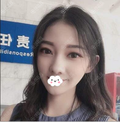 <!--<i data=20240710 data-id=13072></i>-->王权线雕提升术后半年效果 <!--<i data=20240710 data-id=13072></i>-->王权线雕提升术后半年效果