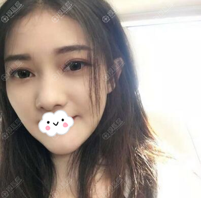 <!--<i data=20240710 data-id=13072></i>-->王权线雕面部吸脂术后6个月效果 <!--<i data=20240710 data-id=13072></i>-->王权线雕面部吸脂术后6个月效果