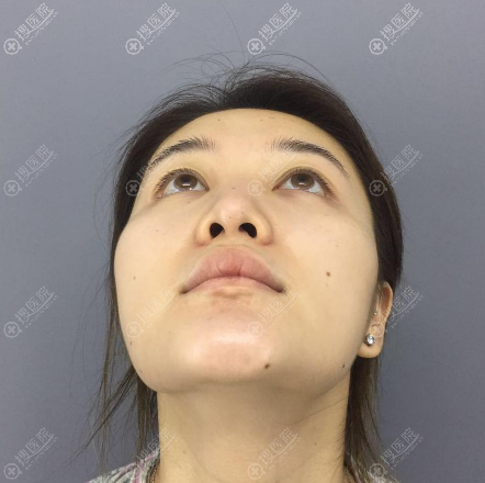通过我的脂肪填充和隆鼻子案例来了解重庆铂生杜亚旭医生怎么样