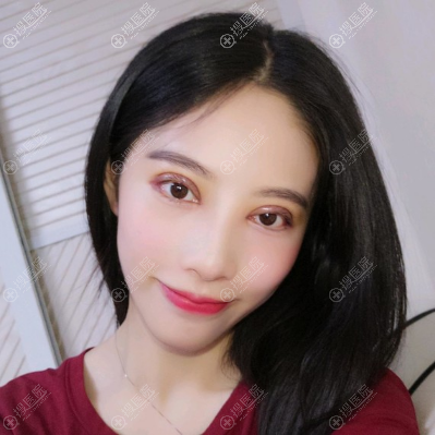 <!--<i data=20240710 data-id=12390></i>-->全切双眼皮术后两天 <!--<i data=20240710 data-id=12390></i>-->全切双眼皮术后两天