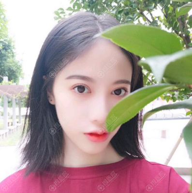 <!--<i data=20240710 data-id=12390></i>-->郝荣涛做的双眼皮好美 <!--<i data=20240710 data-id=12390></i>-->郝荣涛做的双眼皮好美