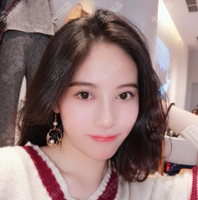 <!--<i data=20240710 data-id=12390></i>-->全切双眼皮术后一个月生活照 <!--<i data=20240710 data-id=12390></i>-->全切双眼皮术后一个月生活照