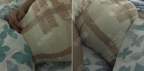 找深圳铭医整形美容医院金光逸做假体隆胸是我深思熟虑的结果