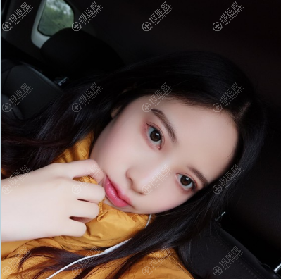 <!--<i data=20240710 data-id=12390></i>-->郝荣涛院长做的全切双眼皮案例图 <!--<i data=20240710 data-id=12390></i>-->郝荣涛院长做的全切双眼皮案例图