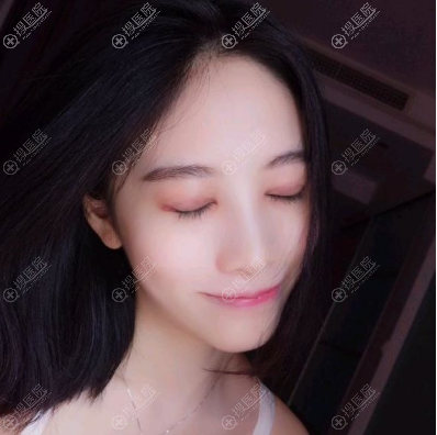 <!--<i data=20240710 data-id=12390></i>-->全切双眼皮术后10天闭眼效果 <!--<i data=20240710 data-id=12390></i>-->全切双眼皮术后10天闭眼效果