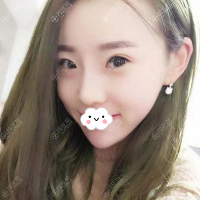 深圳京韩兰茂梵美乔爱军面部脂肪填充效果 深圳京韩兰茂梵美乔爱军面部脂肪填充效果