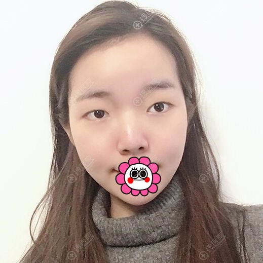 我到兰州韩美整形找马医农做完双眼皮后变化还是挺大的