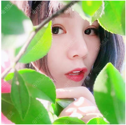 找杭州时光朱若宁做的双眼皮隆鼻很自然 找杭州时光朱若宁做的双眼皮隆鼻很自然