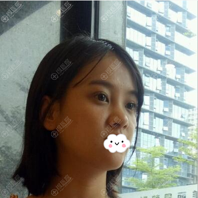 南宁鼻综合哪家好?南宁美丽星李彬彬鼻综合2个月效果图看一下
