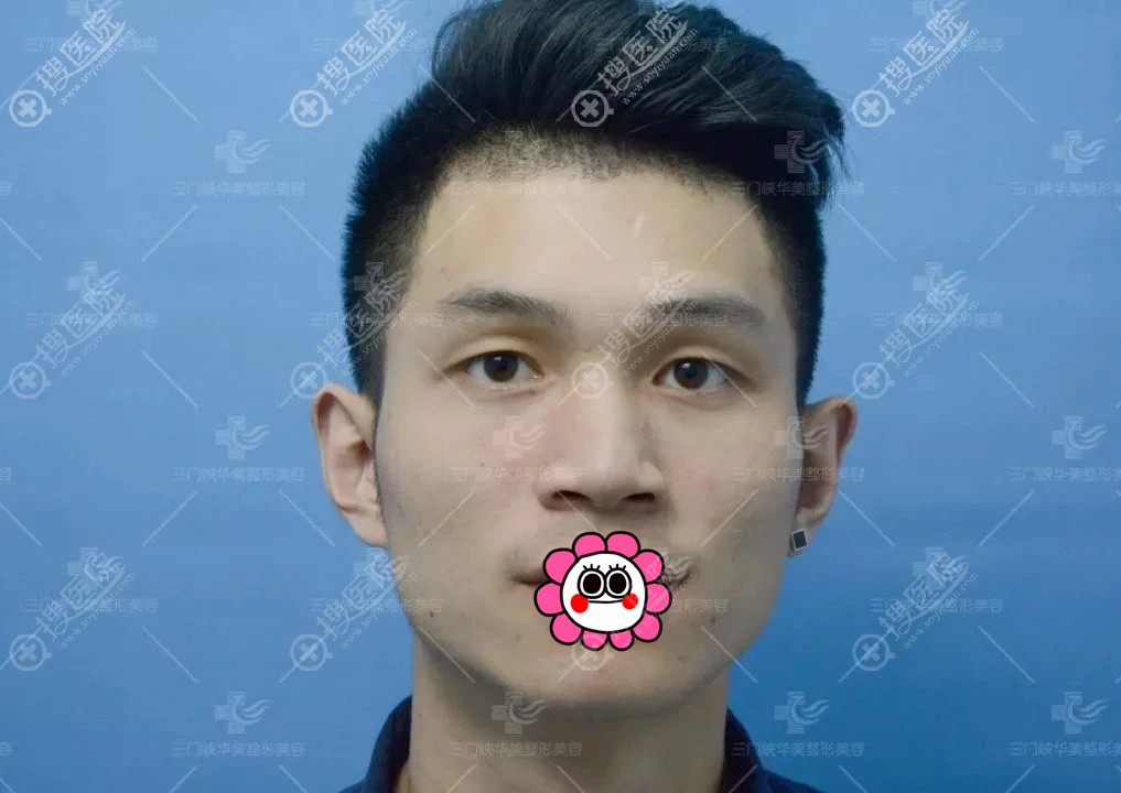 单眼皮的男生到三门峡华美找林海晨做了全切双眼皮,一起来围观