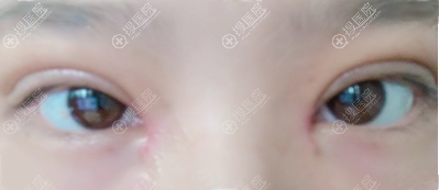 王力佳双眼皮开眼角术后一周效果 王力佳双眼皮开眼角术后一周效果