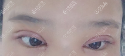 深圳龙华伊婉眼综合术后即刻 深圳龙华伊婉眼综合术后即刻