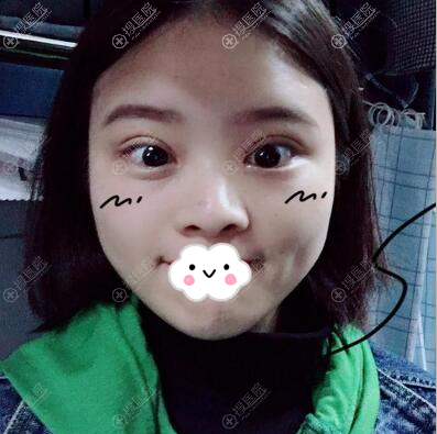 <!--<i data=20240710 data-id=12764></i>-->王力佳双眼皮开眼角3个月 <!--<i data=20240710 data-id=12764></i>-->王力佳双眼皮开眼角3个月