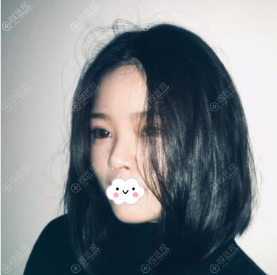 深圳龙华伊婉王力佳眼综合效果 深圳龙华伊婉王力佳眼综合效果