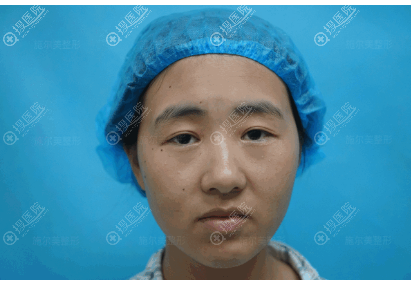 双眼皮失败后闺蜜鼓励我去南京施尔美找孙欣主任做了双眼皮修复